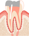 根管治療の治療の流れ