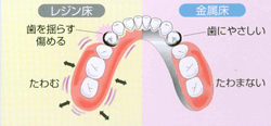 ノンクラスプデンチャー 