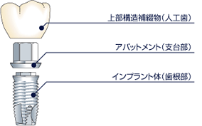 インプラントとは