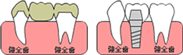 部分入れ歯