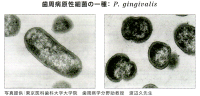 原因はプラーク中の細菌