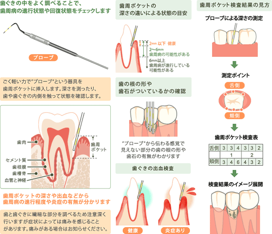 歯周ポケット検査って、なに？